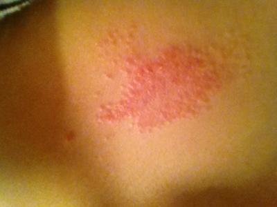 skin rash on chest