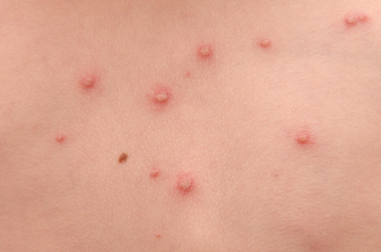 red pimples on skin from chicken pox