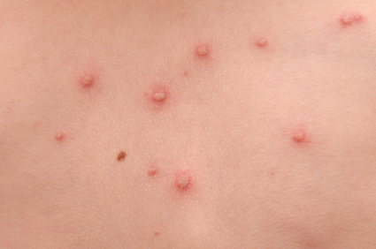 Chicken Pox Vaccine Treatment