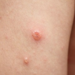 close up of chicken pox on skin