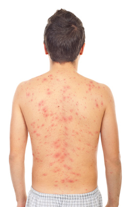 chicken pox rash on skin of back