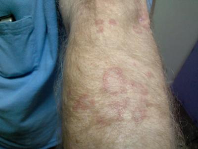 circular skin rash on arm is not ringworm