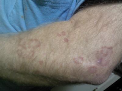 circular skin rash pattern on arm