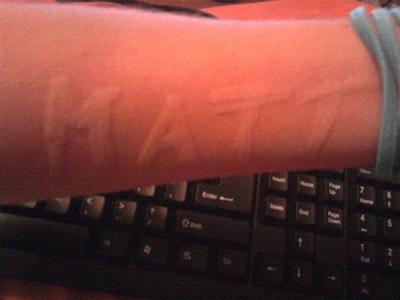 dermatographism sufferer writes name on arm and this is why it is called the skin writing disease