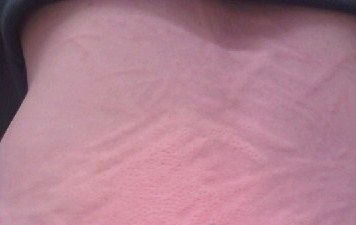 a picture showing raised skin welts caused by dermatographism skin problem