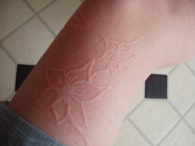 picture of a skin drawing on the leg of an individual with dermatographism