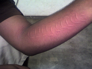 photo showing skin writing on the arm of a person with dermographism
