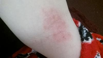 Dry flaky raised itchy rash in the crease of arm.
