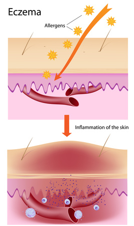 formation of eczema problem on skin