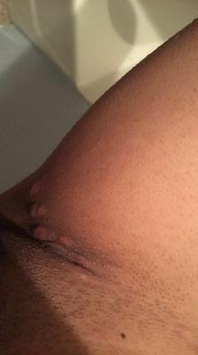 Inflamed itchy bumps on both sides of groin area after scabies infestation.