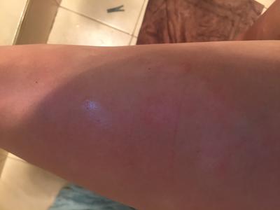insanely itchy rash on leg