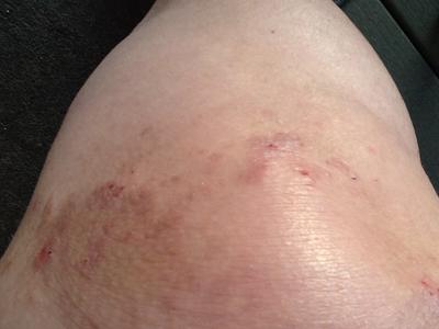 Intense itchy skin rash on knee area.