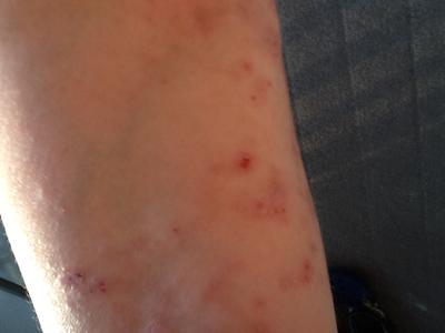 Intense Itchy Skin Rash on Arms and Legs