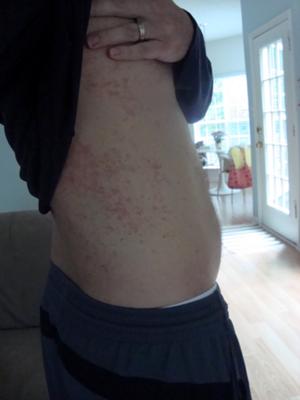 Intense skin rash on side of torso that cannot be treated successfully