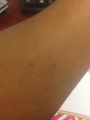 Blotches on Forearm Caused by Dermatographism