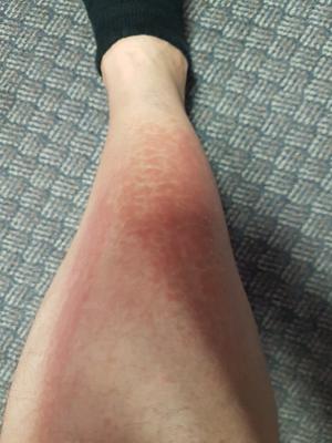 Itchy Red Ankle Rash