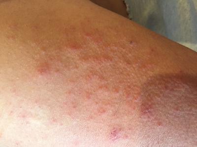 itchy skin rash on arm