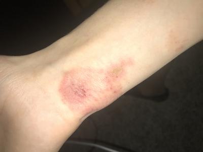 Itchy red rash on wrist.