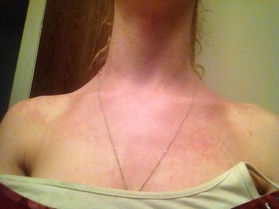 itchy red rash on neck and shoulders