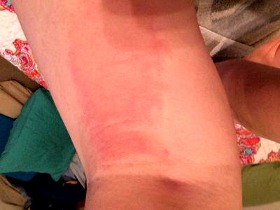 itch red patch of skin on back of leg