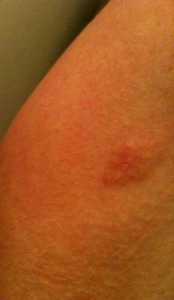 Itchy round red raised rash on the back of arm close to armpit.