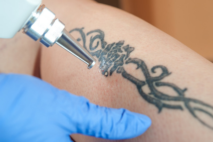 laser tattoo removal technique for fading tattoos