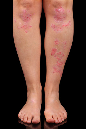 skin rash on legs