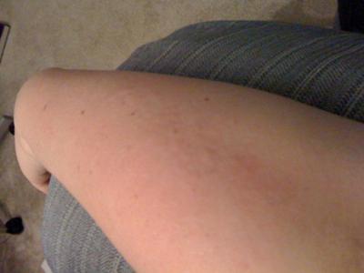Little white bumps rash on arm