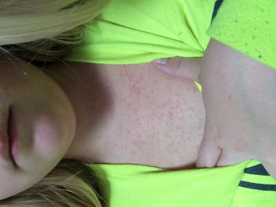 rash on chest that spreads and does not itch but hurts to touch
