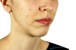 acne pimples on a woman's face