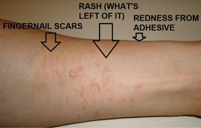 Poison Ivy Looking Skin Rash