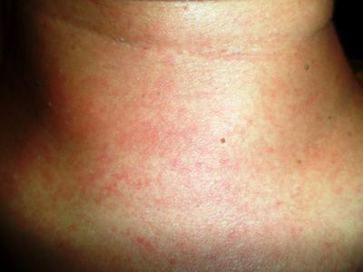 Possible prickly heat rash on neck.