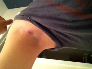 Purple itchy rash in armpit.