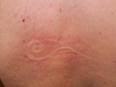 Raised skin welt on the back in the form of a distinct pattern.