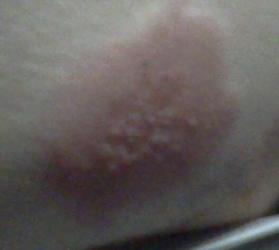 Raised Welt on Skin with Bumps