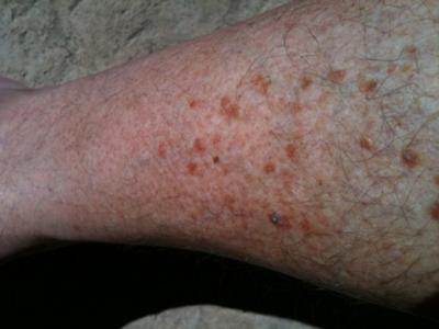 Rash on Shins and Calves