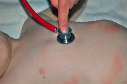 red skin rash on the chest of a child