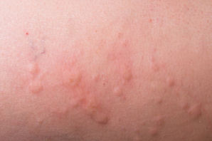 common rashes on the skin