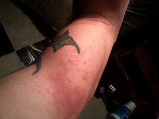 rash on back of thigh