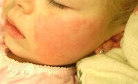skin rash on cheek of baby