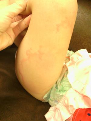 skin rash on thigh of baby