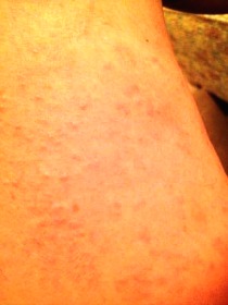 rash with bee stinging feeling