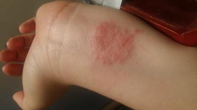 Red and itchy circular rash on wrist.