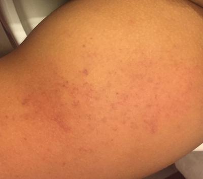 Red rash under skin on inner thigh.