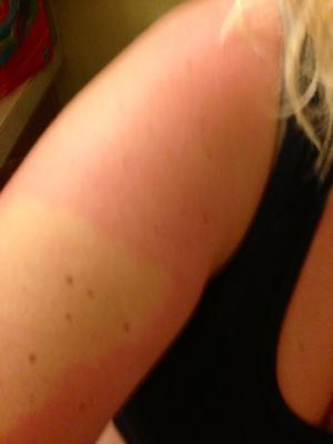 Red burning itch rash on arm.
