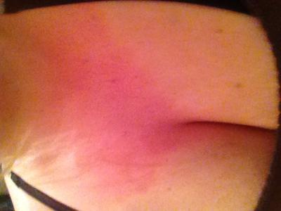 Red burning itch rash on chest reappeared different.