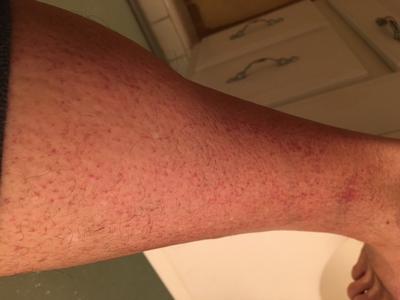 Red scratch like rash on leg.