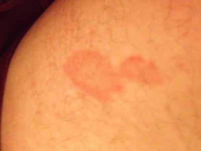 Red skin blotch on inside of thigh