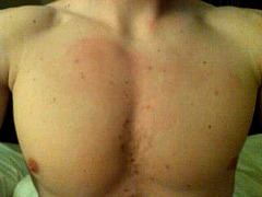 red bumps on chest and back