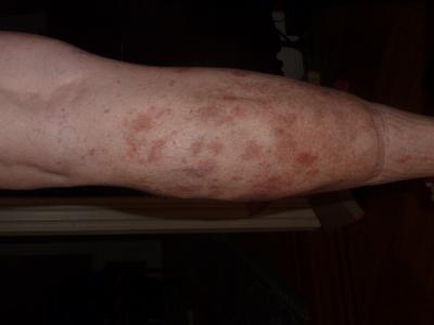 Reddish patches on the calve of my leg that are not itchy and likely caused by medications.